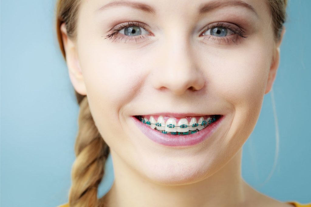 Metal braces on a girl