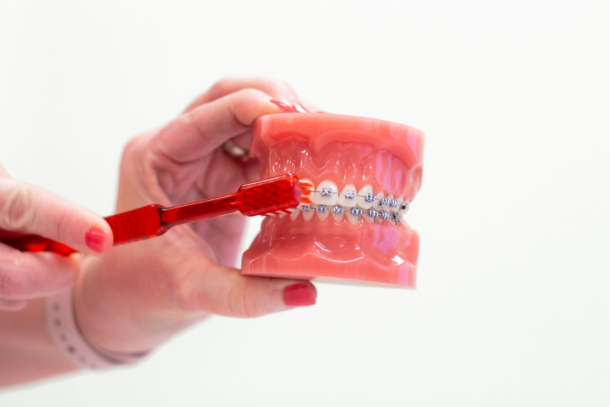 Metal braces